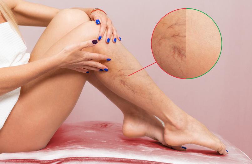 Varices